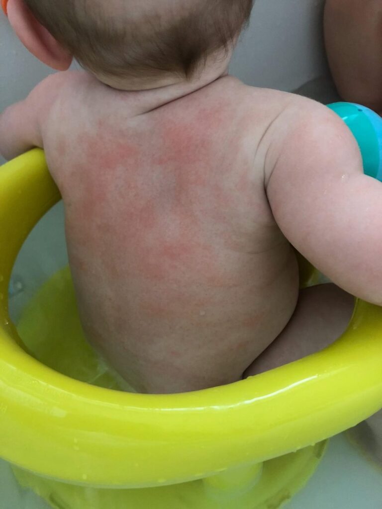 Food Allergy Symptoms: Weaning