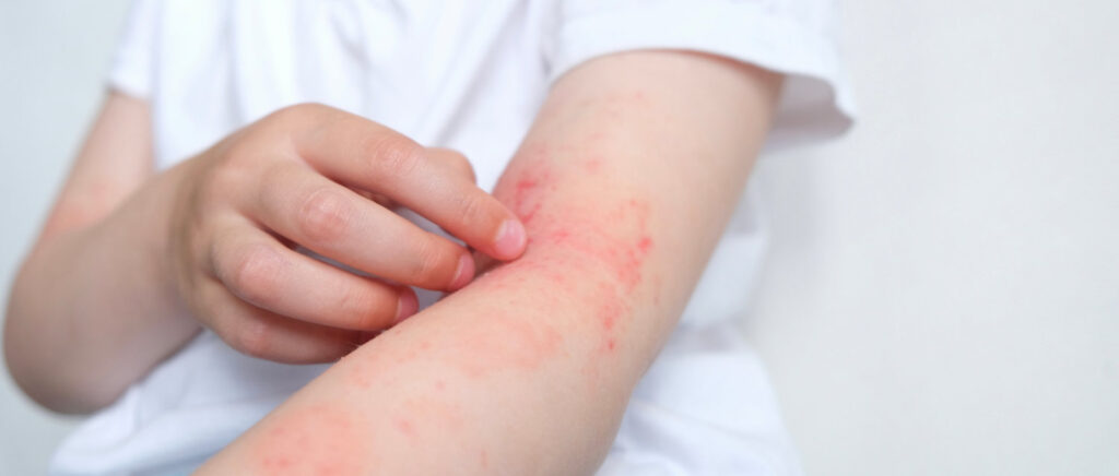 Help - My baby has had an allergic reaction during weaning!