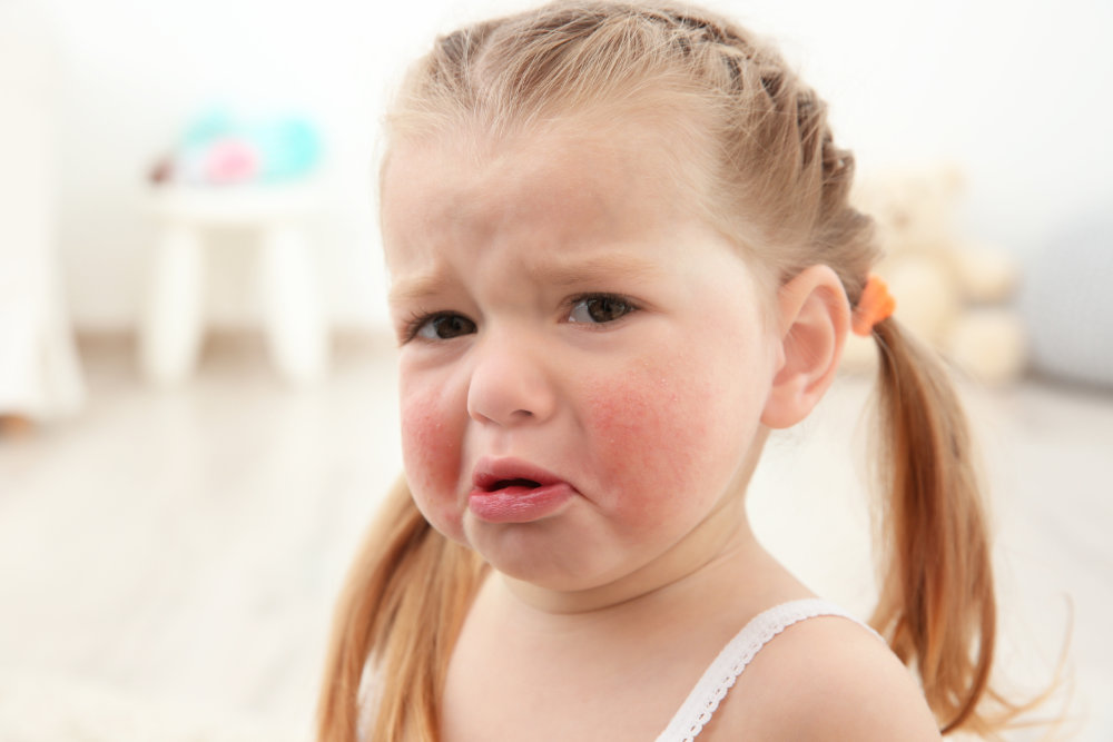 Is My Baby's Rash a Food Allergy?